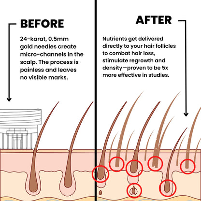 Hair Regrowth System